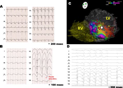 Hybrid Epicardial Ventricular Tachycardia Ablation With Lateral