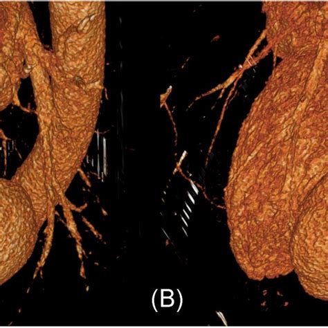 A And B Preoperative Computed Tomography Download Scientific Diagram