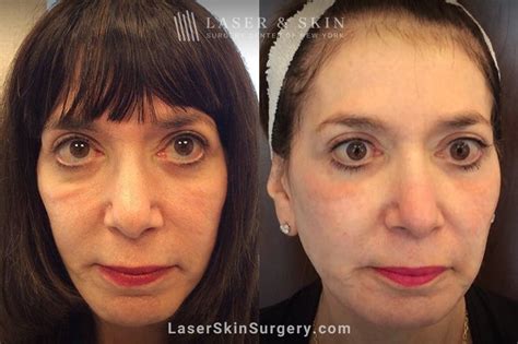 Festoons And Bags Under Eyes New York Ny Laser Center