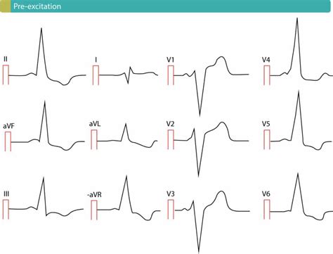 St Segment Elevation In Acute Myocardial Ischemia And Differential