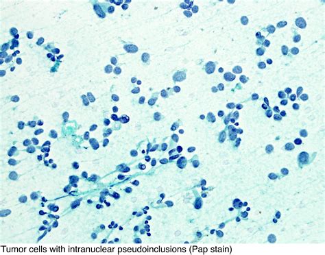 pathology outlines medullary