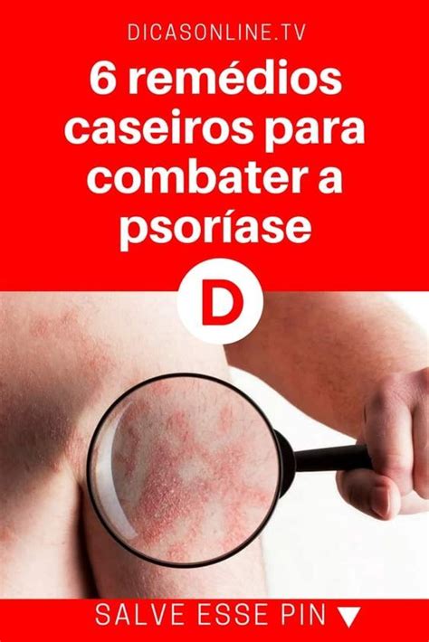 Conhe A As Melhores Op Es Naturais De Tratamento Caseiro Para Psor Ase