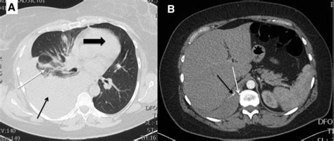 Spontaneous Hemothorax A Rare Face Of Vertebral Osteochondroma