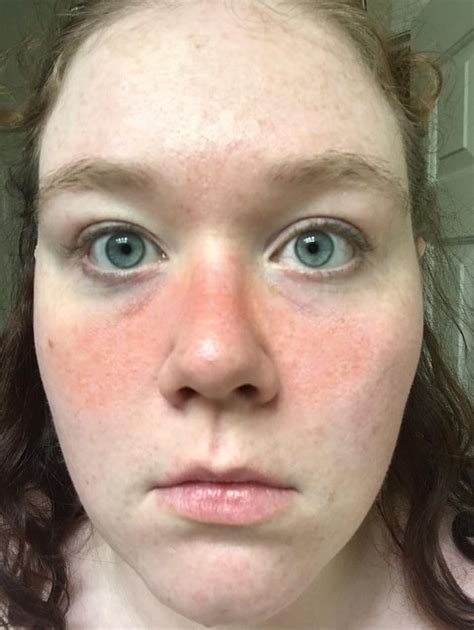 Does Anyone Elses Butterfly Rash Show Up When Youve Been Out In The Sun Pic Rlupus