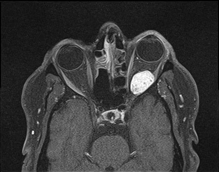 Cavernous Hemangioma Eye