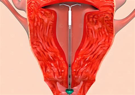 Film Intrauterine Device Medicalgraphics