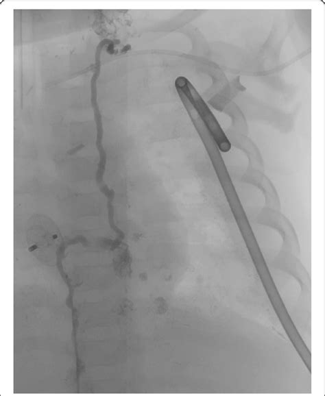 Pre Td Embolization In Patient Pre Td Embolization Imaging Confirms