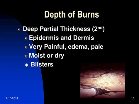 Ppt Burns Powerpoint Presentation Free Download Id3126978