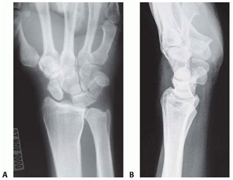 Open Scapholunate Ligament Repair And Augmentation Musculoskeletal Key