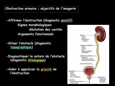 Ppt Imagerie Et Obstruction Urinaire Powerpoint Presentation Free