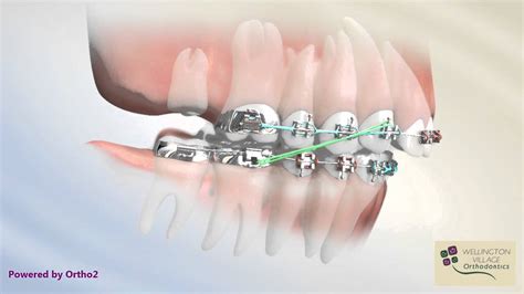 Class Ii Correction With Second Molar Extraction Youtube