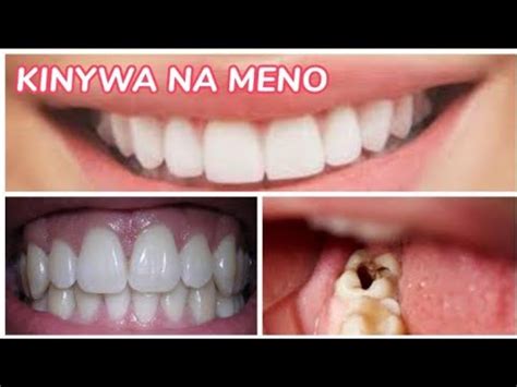 100 KIBOKO YA JINO FIZI NA MENO YALIYO TOBOKA YouTube