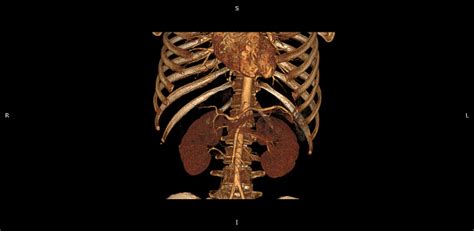 Ct Tubuh 3d Pencitraan Medis Radiologi Perut Resolusi Tinggi Menghitung