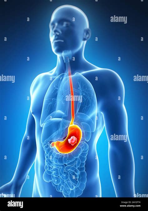 3d Rendered Illustration Of The Male Stomach Cancer Stock Photo Alamy