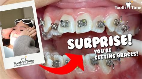 Surprise I Got My Braces Tooth Time New Braunfels Texas Youtube