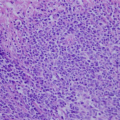 Pdf Intra Abdominal Desmoplastic Small Blue Round Cell Tumor A Case