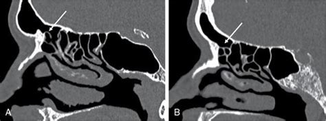 Nose And Paranasal Sinuses Radiology Key