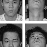 A Preoperative Three Dimensional Facial CT Of The Patient With Tessier