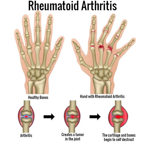 What Is Rheumatoid Arthritis Azalea Orthopedics