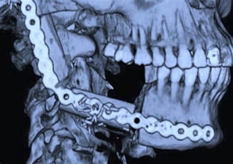 La reconstrucción mandibular y sus avances Hugo Herrera García s Blog