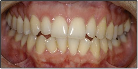 Tongue Squamous Cell Carcinoma In Young Nonsmoking And Nondrinking Patients 3 Clinical Cases Of