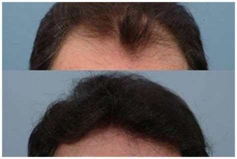 Results of Finasteride use in men. Before and after images.