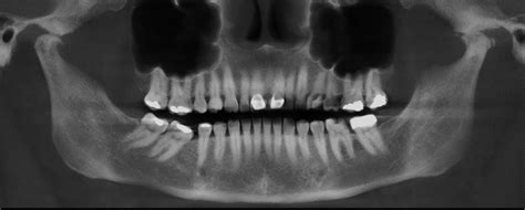 Osteoartrosis de ATM Dento Metric Radiología Dental Oral y