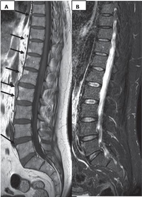 Figure 2 from spondyloarthropathy spinal MRI lesion specific for axial ...