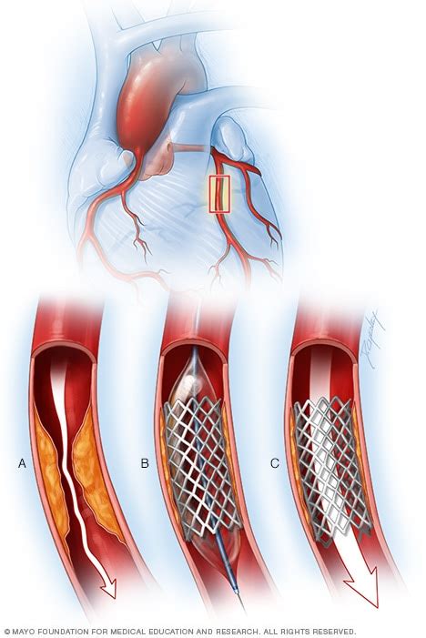 coronary artery stent mayo clinic