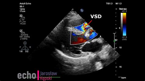 Ventricular Septal Defect #VSD #echocardiography echo congenital heart ...