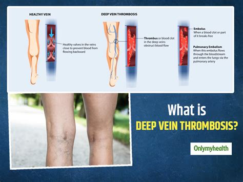 Deep Vein Thrombosis Dvt Symptoms Causes And 57 Off