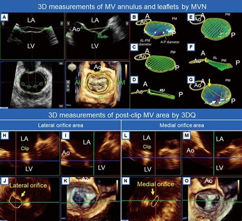 3d Mitral Valve Mv Quantitative Analysis Upper Mitral Valve