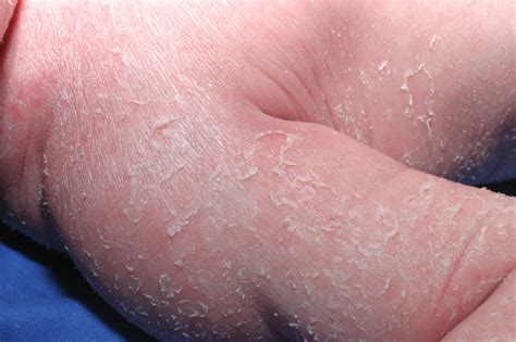 Congenital Ichthyosis Erythroderma