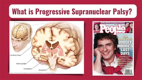 What Is Progressive Supranuclear Palsy Steele Richardson Olszewski Syndrome Or Dudley Moore