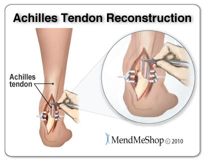 Rupture of the Achilles Tendon