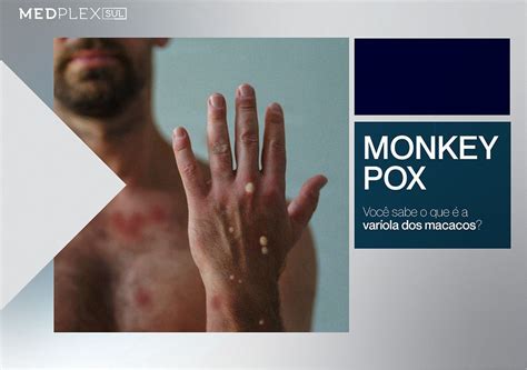 Monkeypox O Que Voc Sabe Sobre A Doen A