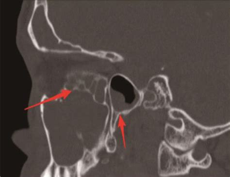 Individual With Chronic Maxillary Sinusitis A Bilateral Chronic Download Scientific Diagram