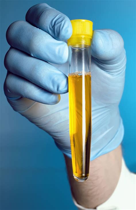 Pus Cells In Urine Normal Range What Do The Levels 43 Off