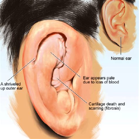 Cauliflower Ear Surgery