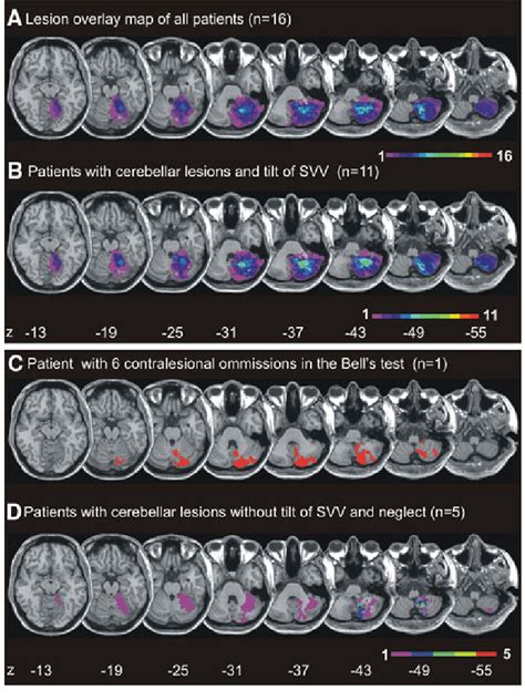 A Overlay Lesion Map Of All Patients With Cerebellar Lesions The