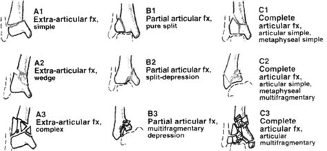 Distal Tibia Fracture Classification