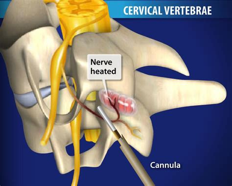 Interventional Pain And Spine Centers Procedures That Dr Sabiha Khadim