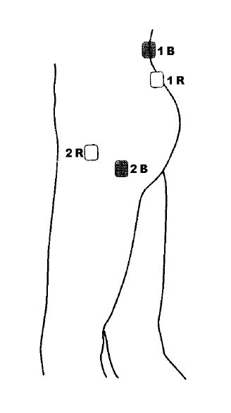 Tens Unit Placement For Hip Bursitis