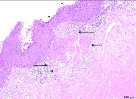 Squamous Cell Carcinoma Histology Labeled The Best Porn Website