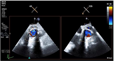 -Transthoracic echocardiogram (TTE) images centered at the aortic valve... | Download Scientific ...