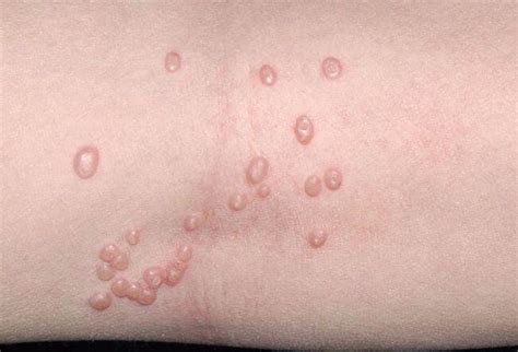 Molusco Contagioso Infección Dermatológica Frecuente En Vacaciones