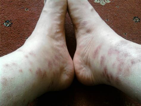 Bites Around Ankles Pictures Photos