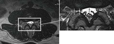 Conservative Treatment of Degenerative Lumbar Scoliosis | IntechOpen