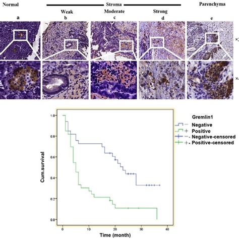 Gremlin Is Overexpressed In Pancreatic Cancer Tissue And Correlates