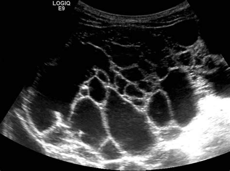 Compva: Imaging — Lymphatic malformation